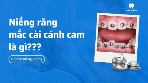Niềng răng mắc cài cánh cam là gì? Có nên niềng?